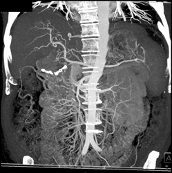 Hepatoma - CTisus CT Scan