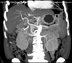 Hepatocellular Carcinoma (HCC) - Neovascularity - CTisus CT Scan