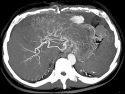 Hepatocellular Carcinoma (HCC) - CTisus CT Scan