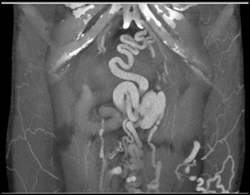 Incredible Varices - CTisus CT Scan