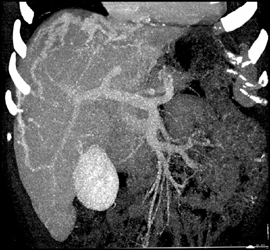 Collaterals in Liver Surface - CTisus CT Scan