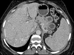 Collaterals in Liver Periphery - CTisus CT Scan