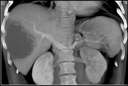 Hemangioma - CTisus CT Scan