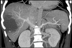 Hemangioma - CTisus CT Scan