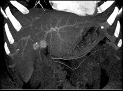 Metastatic Islet Cell Tumor - CTisus CT Scan