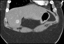 Metastatic Islet Cell Tumor - CTisus CT Scan