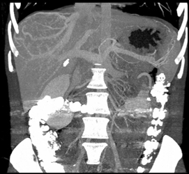 Late Phase Focal Nodular Hyperplasia (FNH) - CTisus CT Scan