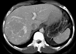 Focal Nodular Hyperplasia (FNH) - Late Phase - CTisus CT Scan