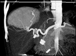 Focal Nodular Hyperplasia (FNH) - CTisus CT Scan