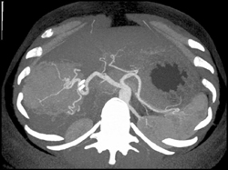 Focal Nodular Hyperplasia (FNH) - CTisus CT Scan