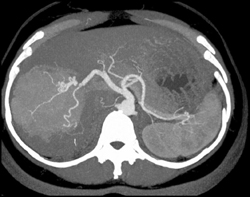 Focal Nodular Hyperplasia (FNH) - CTisus CT Scan