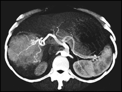 Focal Nodular Hyperplasia (FNH) - CTisus CT Scan