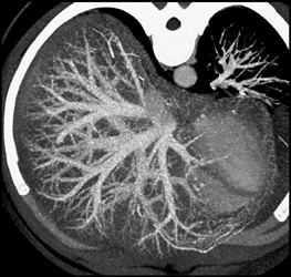 Normal Anatomy - CTisus CT Scan