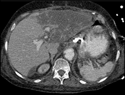 Hepatic Infarction - CTisus CT Scan