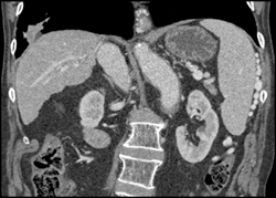 Varices Seen Around Spleen - CTisus CT Scan