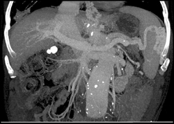 Varices in and Around Spleen - CTisus CT Scan