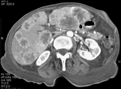 Metastatic Islet Cell Cancer - CTisus CT Scan