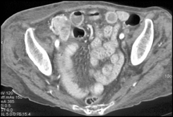 Implants in RLQ - CTisus CT Scan