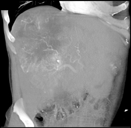 Hepatoma - CTisus CT Scan