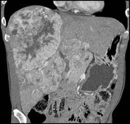 Hepatoma - CTisus CT Scan