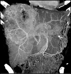 Hepatoma - CTisus CT Scan