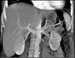 Hemangioma - CTisus CT Scan