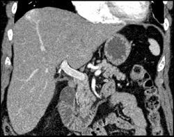 Hemangioma - CTisus CT Scan