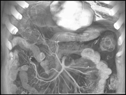 Cirrhosis - CTisus CT Scan