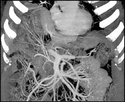 Cirrhosis - CTisus CT Scan