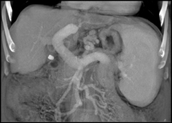 Cirrhosis and Huge Varices - CTisus CT Scan