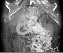 Huge Abdominal Wall Varices - CTisus CT Scan