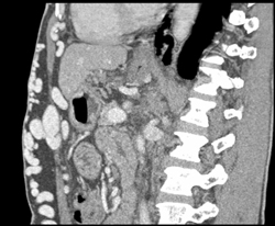 Varices in Abdominal Wall (MIP/VRT) - CTisus CT Scan