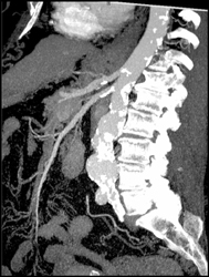 Atherosclerotic Changes Celiac/SMA - CTisus CT Scan