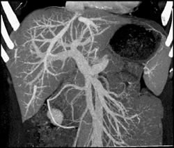 Normal Hepatic Veins (VRT/MIP) - CTisus CT Scan