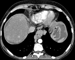 Cirrhosis With Regenerating Nodules - CTisus CT Scan