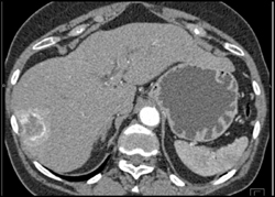 Hemangioma - CTisus CT Scan