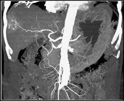 Hemangioma - CTisus CT Scan