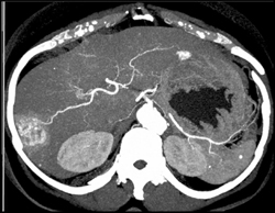 Hemangioma - CTisus CT Scan