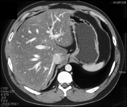 Fatty Liver - CTisus CT Scan