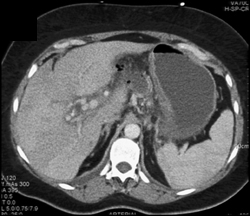 Cavernous Transformation of the Portal Vein (CTPV) With Collaterals - CTisus CT Scan