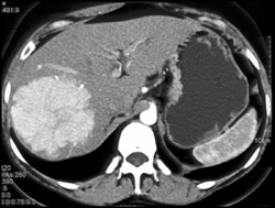 Focal Nodular Hyperplasia (FNH) - CTisus CT Scan