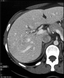 Focal Nodular Hyperplasia (FNH) - Nice Washout - CTisus CT Scan