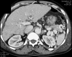 Portal Vein Thrombosis (PVT) and Cirrhosis - CTisus CT Scan