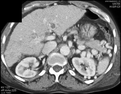 Hepatocellular Carcinoma (HCC) and Portal Vein Thrombosis (PVT) - CTisus CT Scan