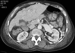 Hepatocellular Carcinoma (HCC) and Cirrhosis - CTisus CT Scan