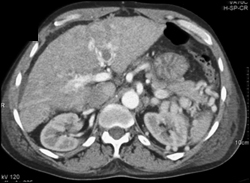 Cavernous Transformation of the Portal Vein (CTPV) and Clot in Portal Vein (PV) - CTisus CT Scan