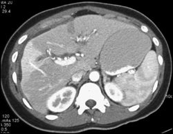 Cholangiocarcinoma - CTisus CT Scan