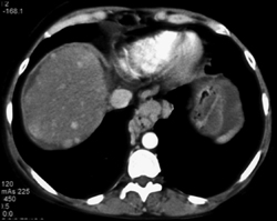 Regenerating Nodules and Varices in the Esophagus - CTisus CT Scan