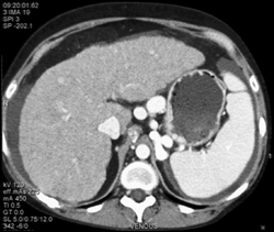 Huge Varices - CTisus CT Scan