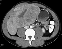 Hepatoma - CTisus CT Scan